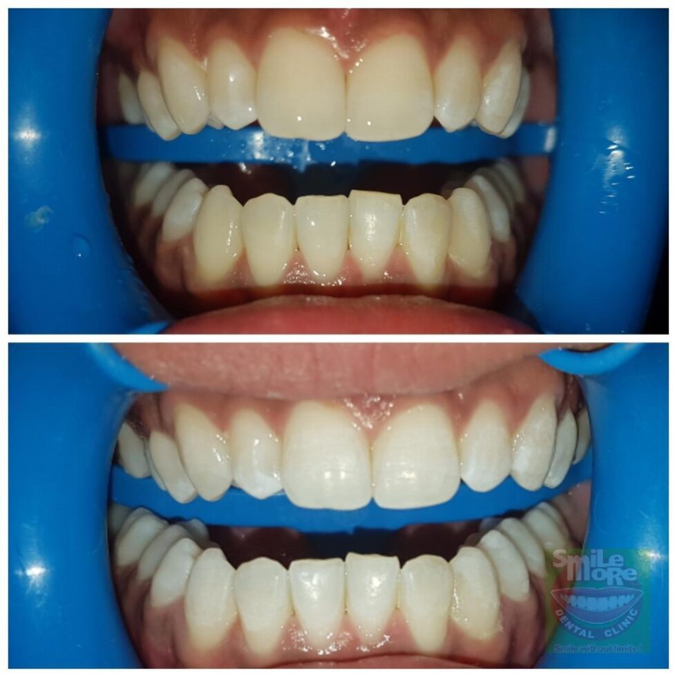 Professional Teeth Whitening in Manila, Philippines Whiter Teeth
