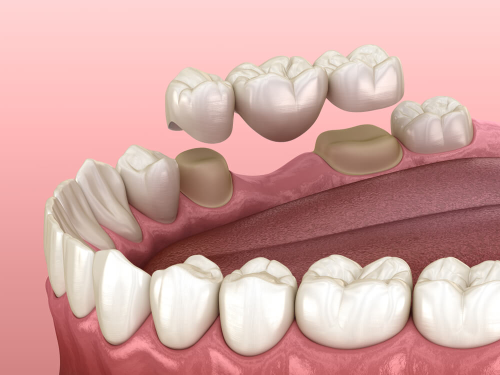 a 3 unit dental bridge to replace the gap of single missing tooth
