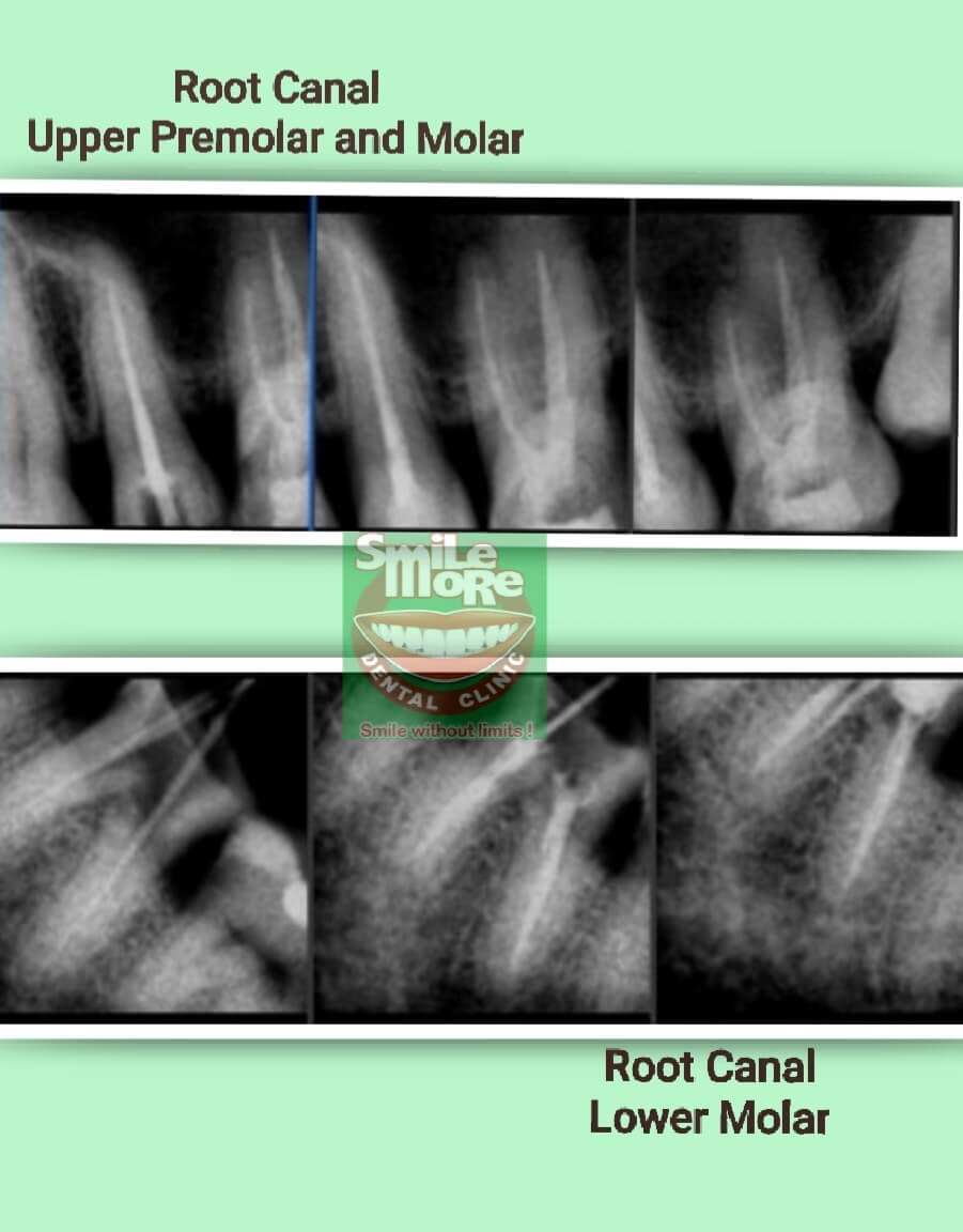 Root Canal (Endodontic) Treatment Samples